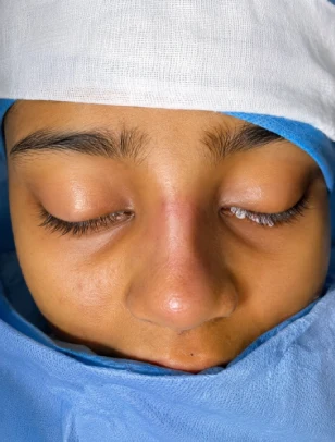 Scarless Rhinoplasty After