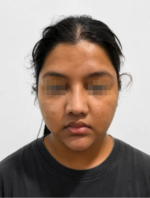 Open Rhinoplasty After