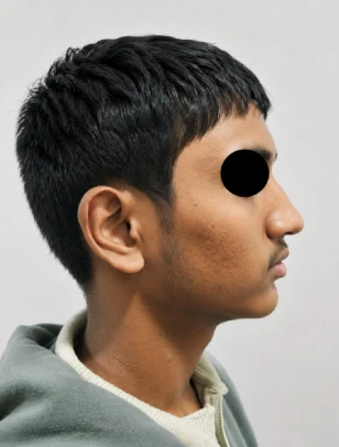 Revision Open Rhinoplasty After