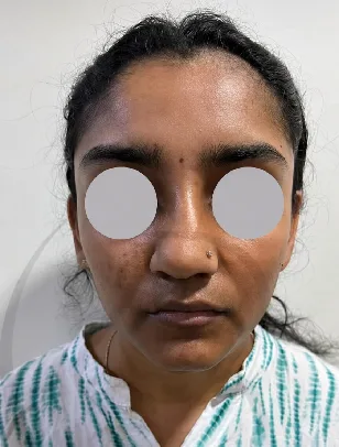 Scarless Rhinoplasty Before