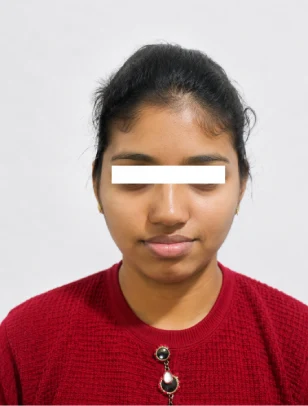 Rhinoplasty & Sinus Surgery After